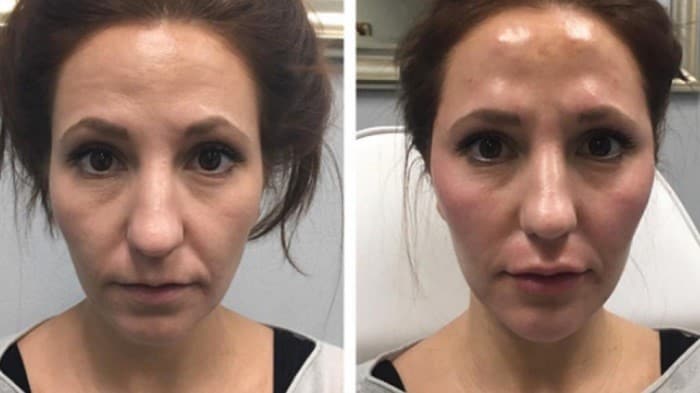 از بین رفتن بافت چربی (لیپوآتروفی) و ژل اسکالپترا