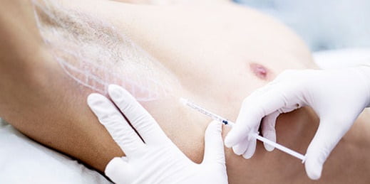 بوتاکس زیر بغل چگونه عمل می&zwnj;کند؟