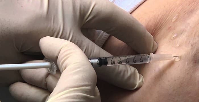 تزریق بوتاکس برای رفع تعریق زیاد زیر بغل گونه انجام می&zwnj;شود؟