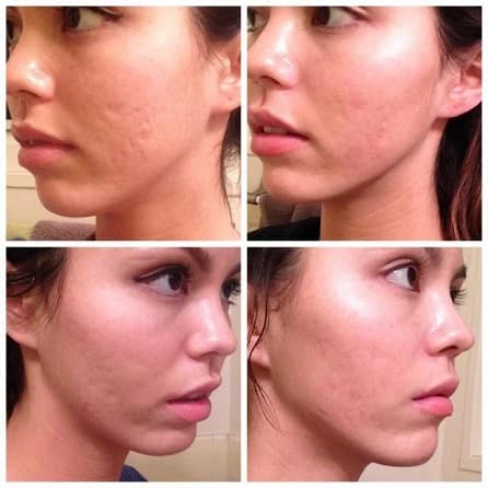 تعداد جلسات درمان