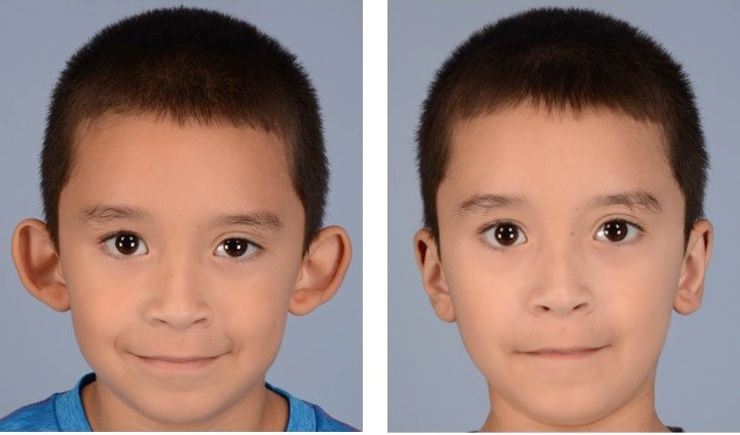 جراحی اتوپلاستی