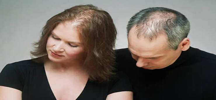 طاسی آندروژنیک