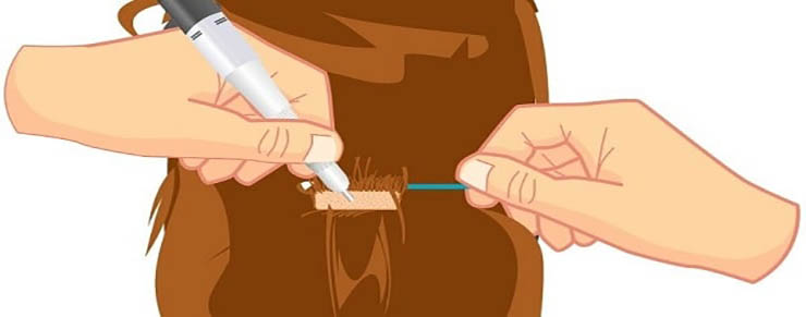 مراحل کاشت موی زنان