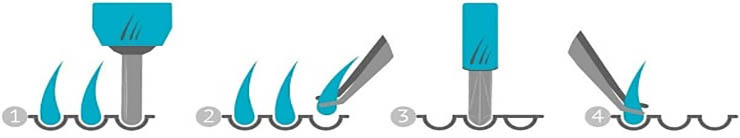 مراحل کاشت مو در زنان عبارتند