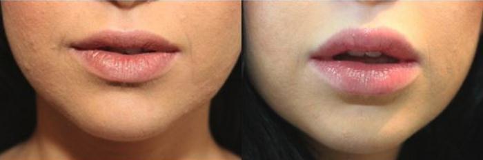 مراقبت&zwnj;های بعد از تزریق ژل به لب