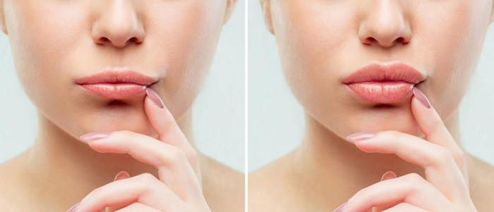 مزایا پرکننده&zwnj;های رستلین