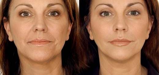 نحوه تزریق ژل خط خنده