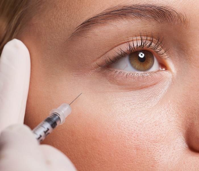 تزریق ژل ژوویدرم در ناحیه زیر چشم